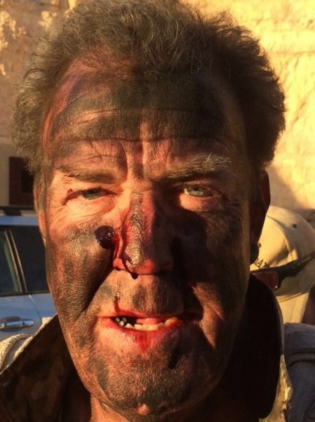 clarkson bleeding 449x600 at Clarkson Steals New Top Gear’s Thunder with a Gross Tweet!